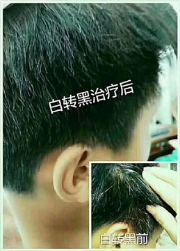 出现白发说明身体机能跟气血的衰退