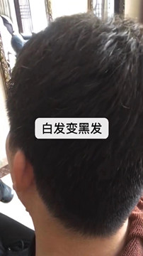 白发的预防方法