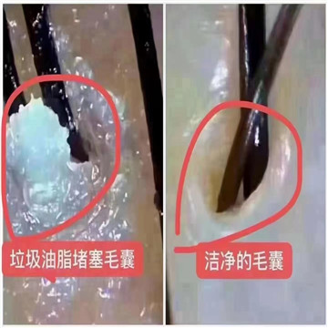 头皮屑在医学上称为头皮糠疹