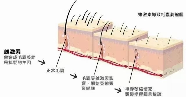 雄性激素导致毛囊