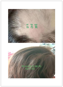 你的头发掉到什么程度，才会认真对待呢？