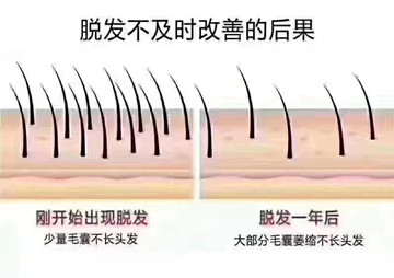 脱发的根本原因——毛囊罢工