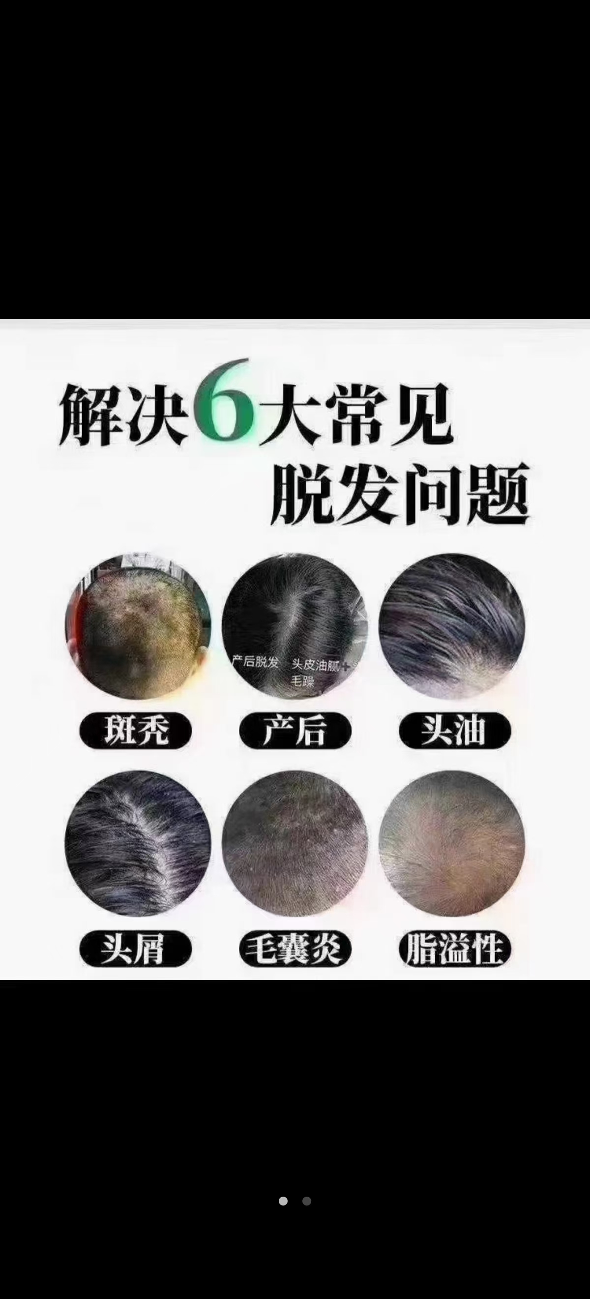 脱发的主要病因