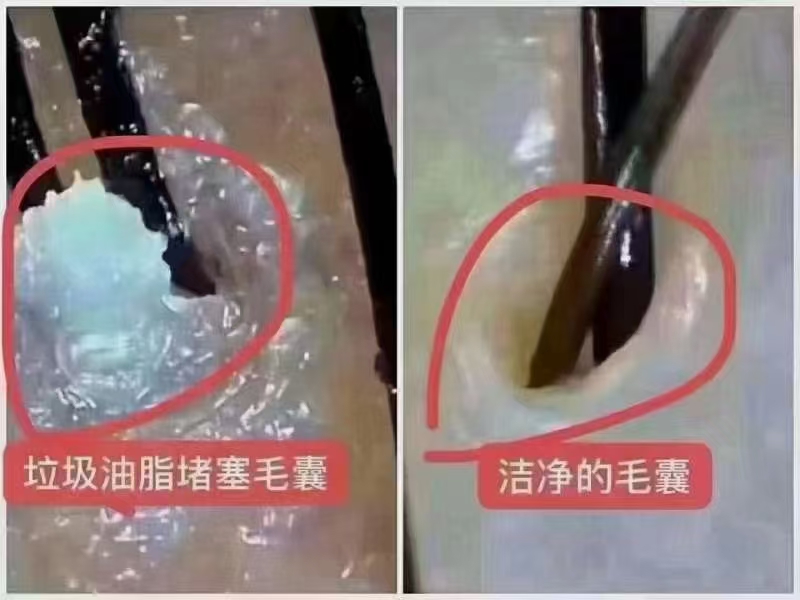 深层头皮护理很重要