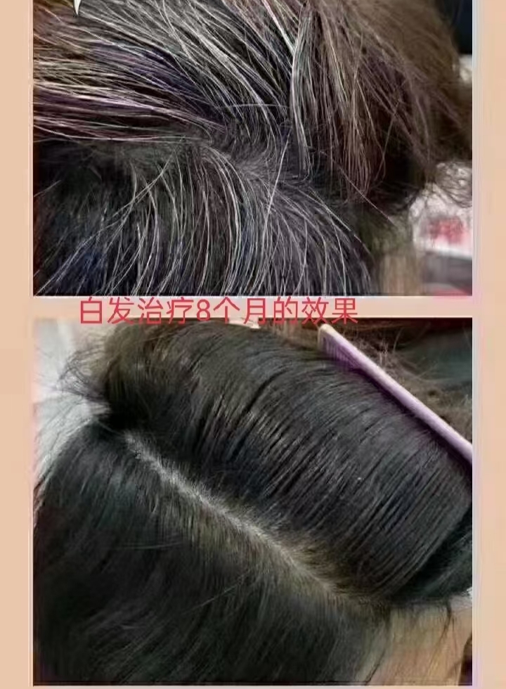 白发越来越趋向于年轻化