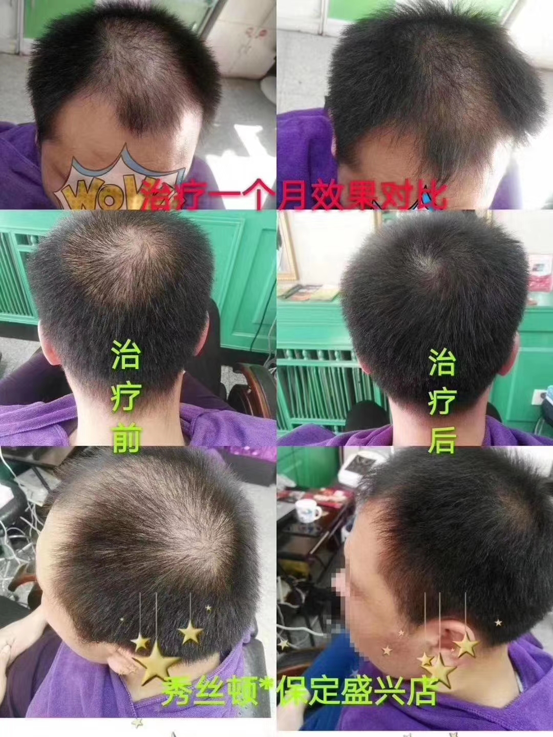 脱发和发际线越来越高什么原因❔