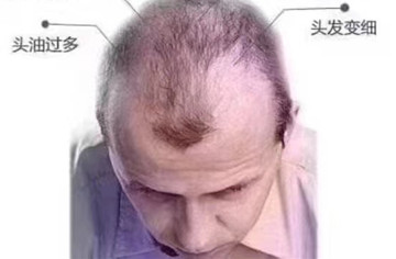 脂溢性脱发最直观的感受就是