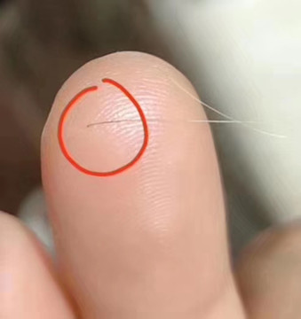 前额白发怎么了？