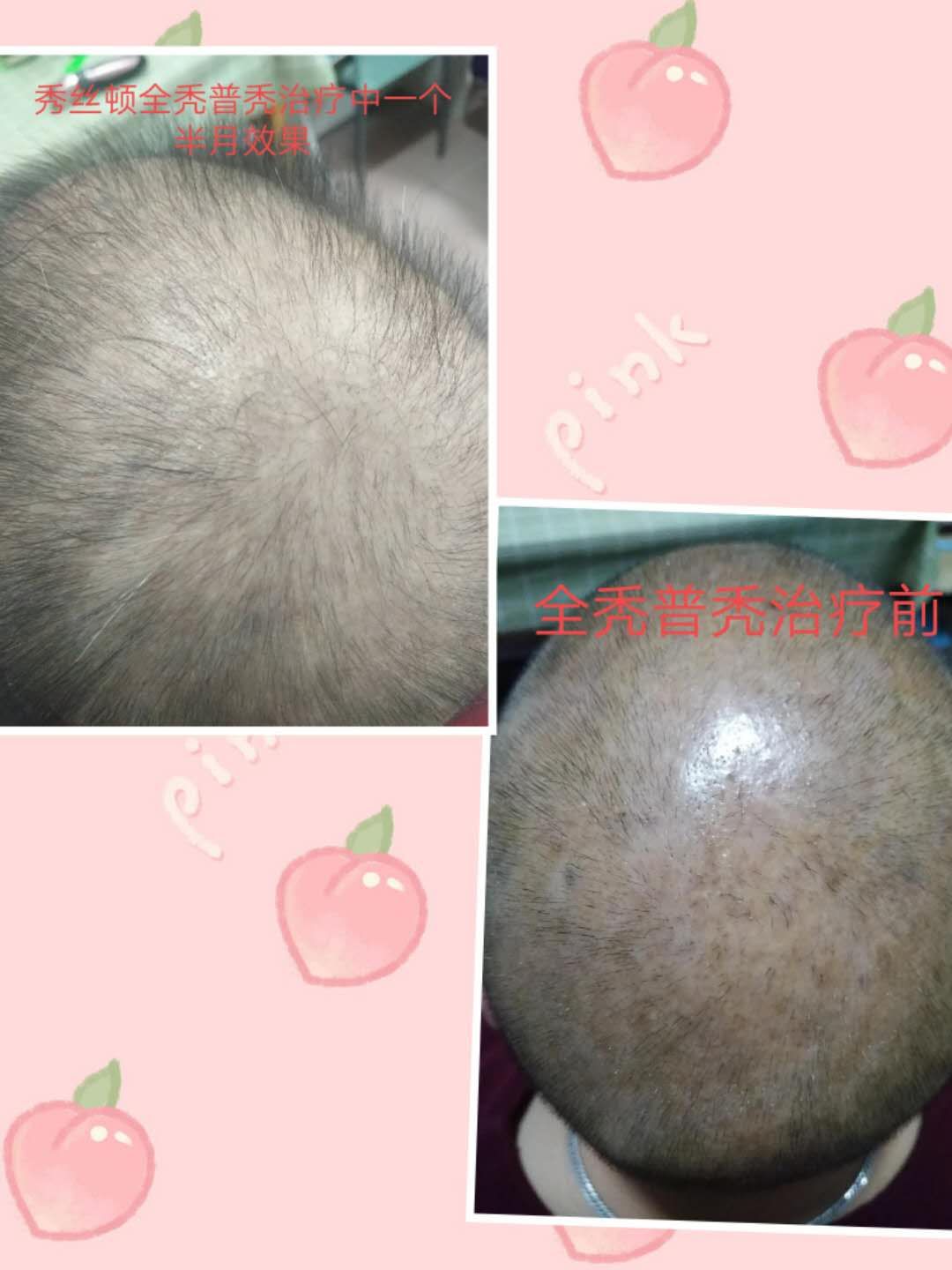 脂溢性脱发在治疗期间