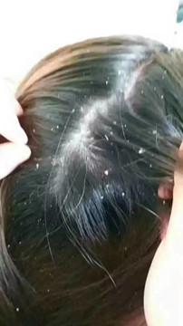 头屑多了该怎么办