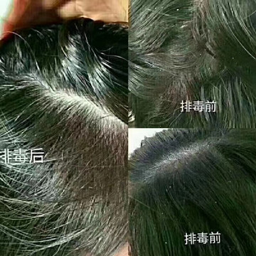 头屑多了该怎么办?