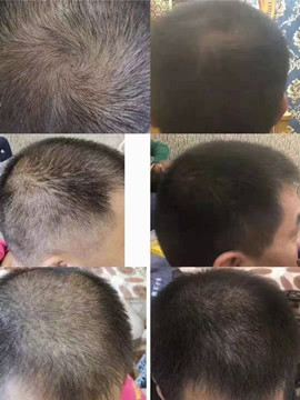 kPT自然免疫疗法的真实效果