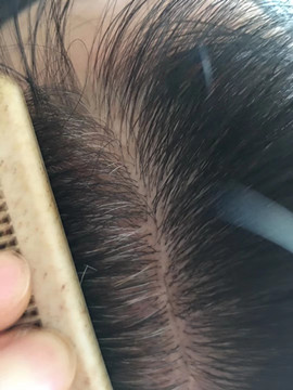 慢性消耗性疾病时也可能出现白发