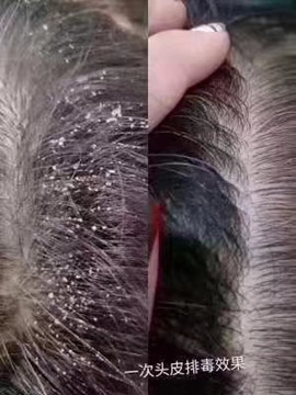 不要以为这只是简单的头皮屑