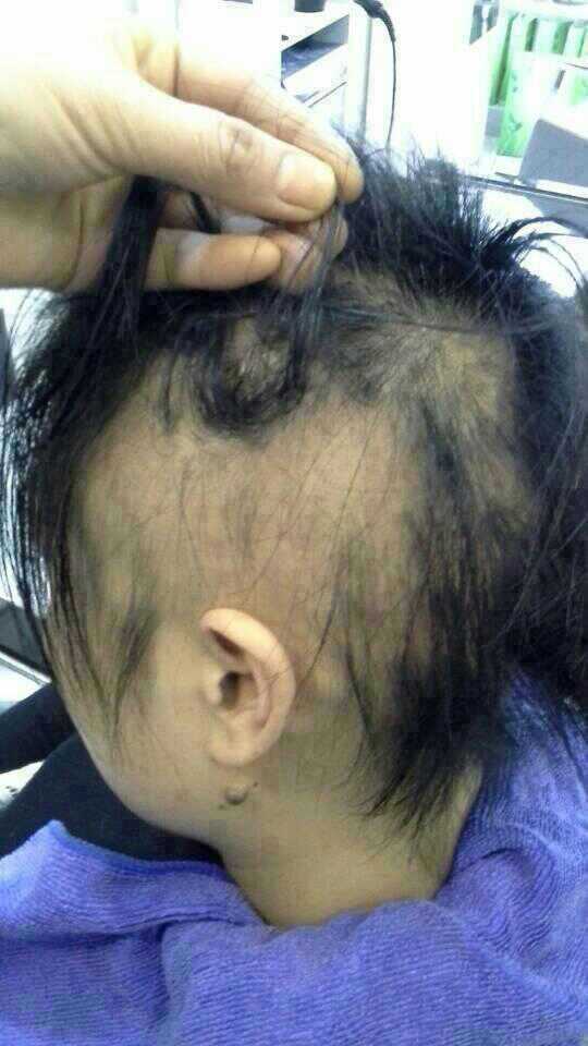 斑秃俗称为“鬼剃头”