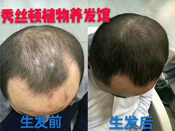 “脂溢性脱发”