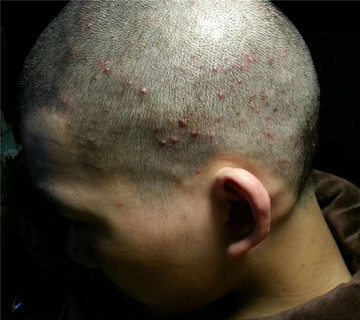 “斑秃”是困扰许多人的常见脱发现象