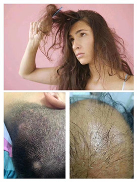 脱发秃顶一般多见于男性脱发