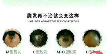 为什么植物养发一次养发做四次
