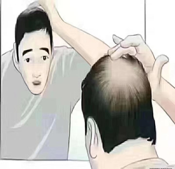 脂溢性脱发症状