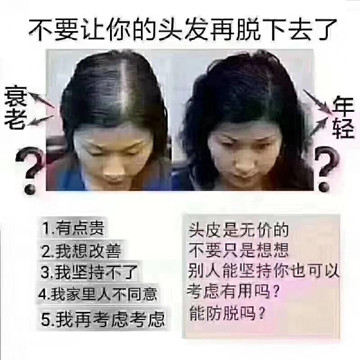 什么是男性型脱发