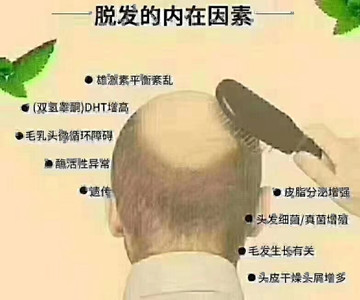什么是男性型脱发