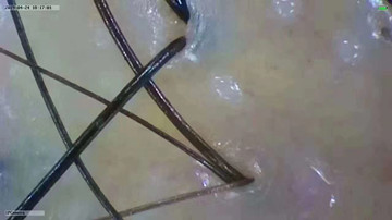 养发馆治白发为啥要拔？