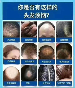 头发主要成份是角蛋白