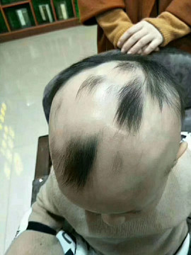 斑秃”是困扰许多人的常见脱发现象