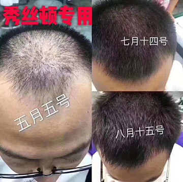 脂溢性脱发就是雄激素性脱发