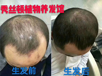 秀丝顿南京植物养发馆告诉你关于生发的方法