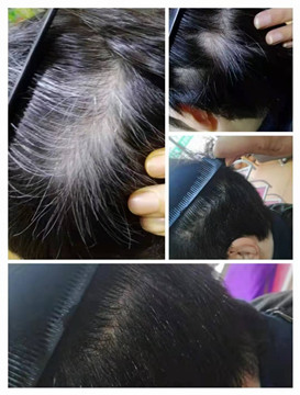 秀丝顿植物养发馆之去头皮屑小窍门