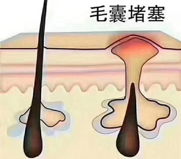 秀丝顿植物养发馆之头皮衰老会引起头皮头发营养输送功能下降