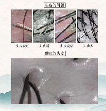 秀丝顿周口在植物养发馆之产后脱发问题