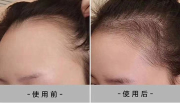 秀丝顿植物养发馆加盟之年轻人长白发是什么原因