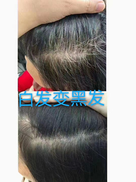 秀丝顿植物养发加盟之新生的头发很小很短就掉了