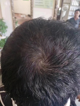 秀丝顿植物养发馆加盟之通过食疗来缓解白发