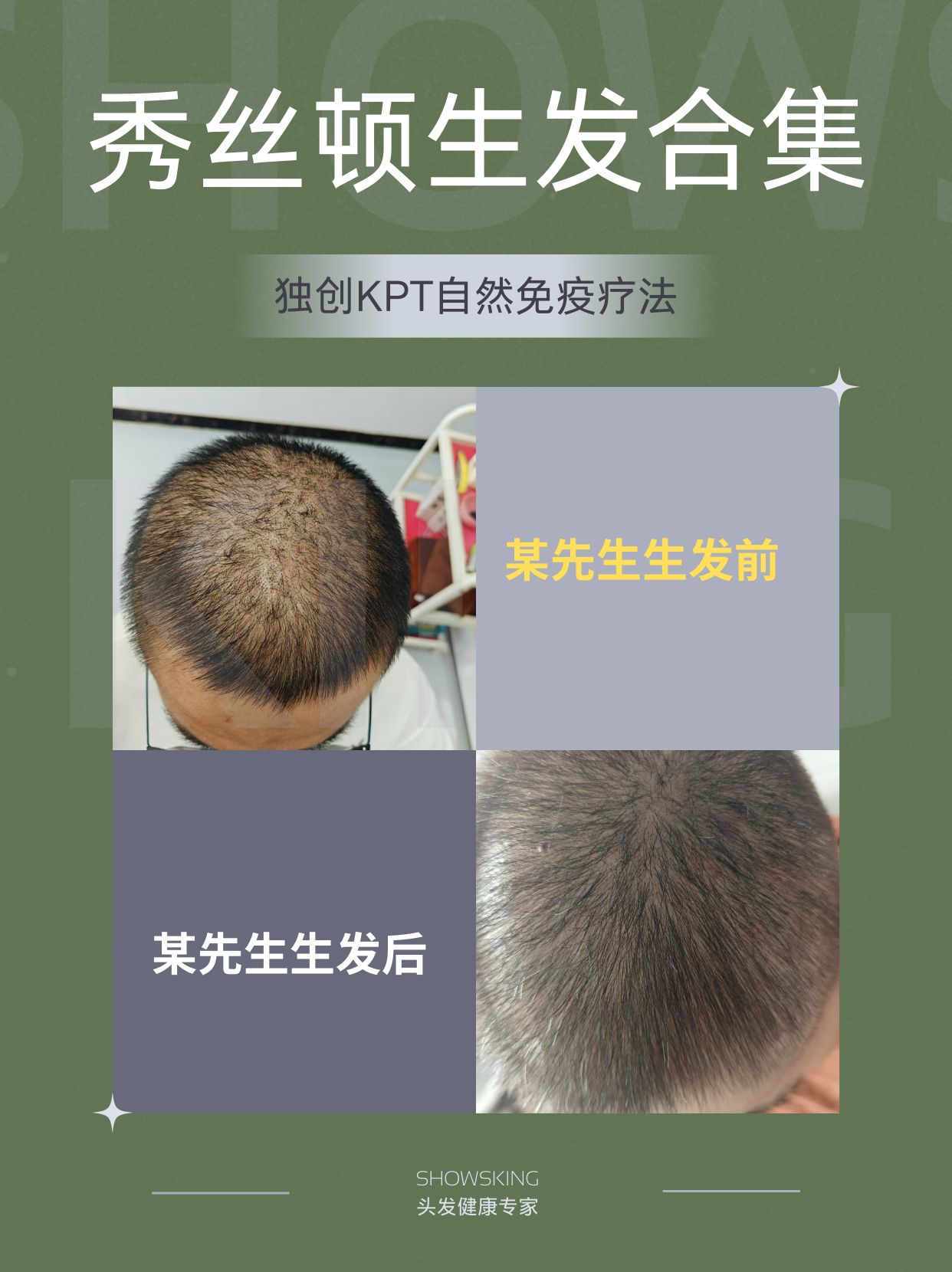 生发效果展示