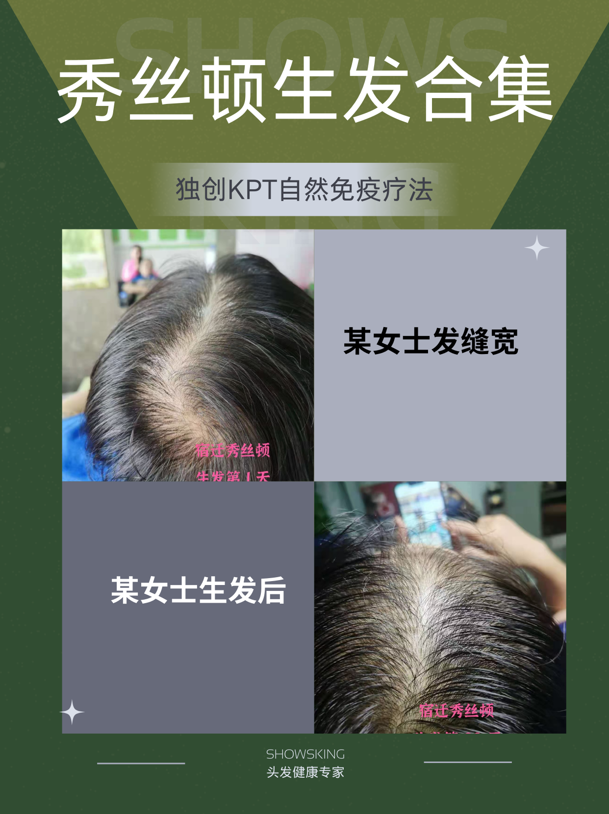 生发效果展示