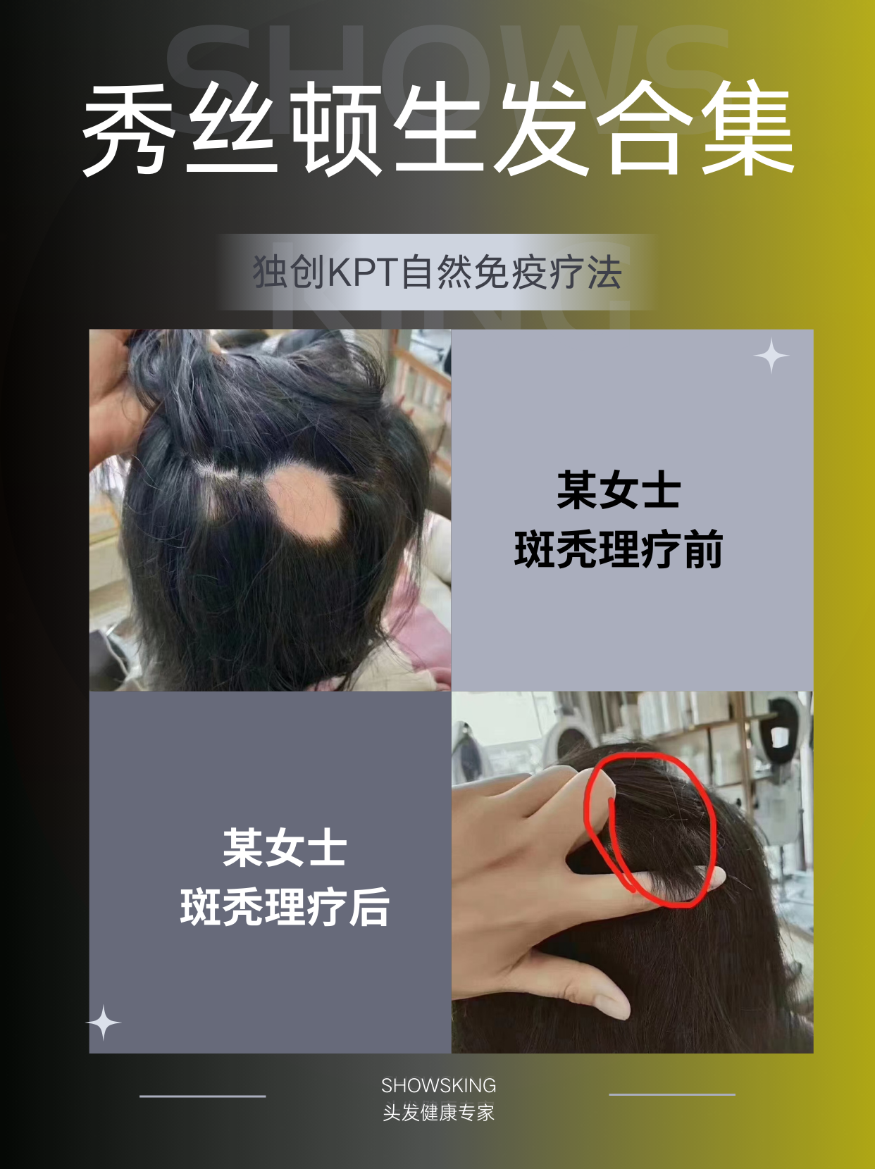 斑秃效果展示