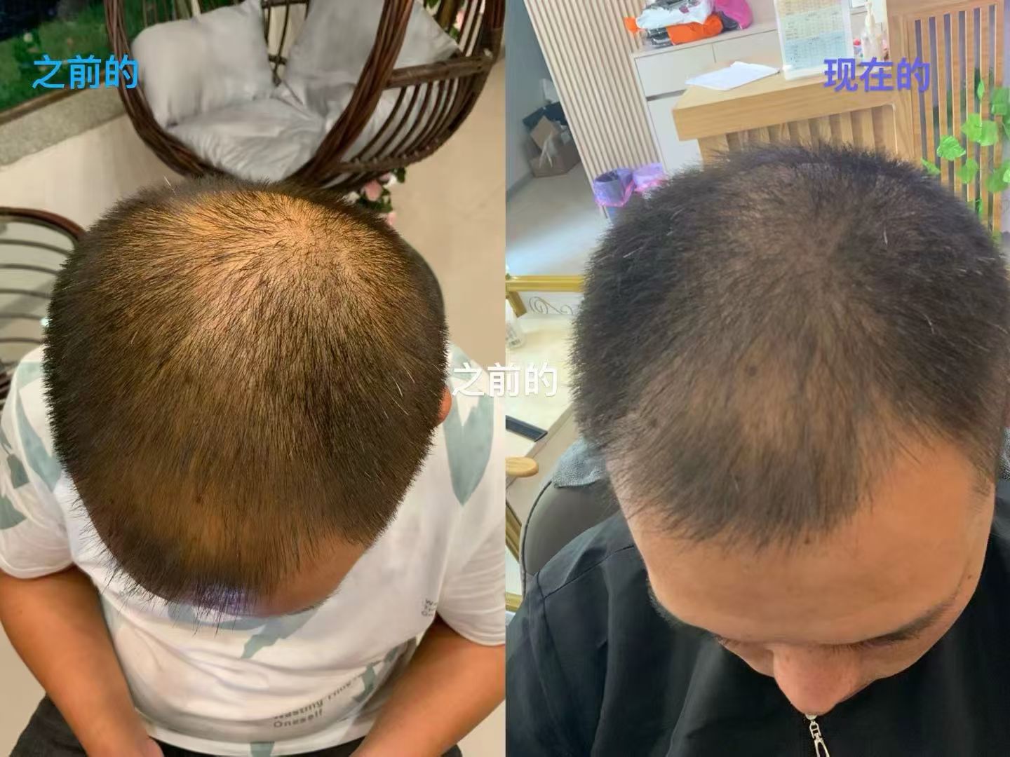 蓬溪店生发效果
