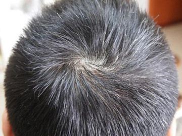秀丝顿植物养发加盟之白发能不能拔？